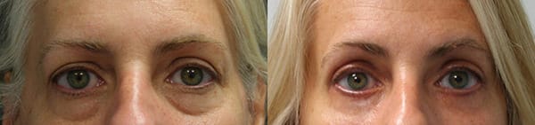Eyelid Surgery Before & After - Dr. Thomassen