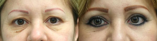 Eyelid Surgery Before & After - Dr. Thomassen