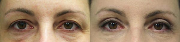 Eyelid Surgery Before & After - Dr. Thomassen