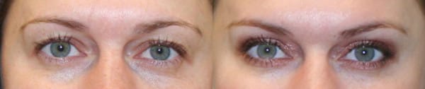 Eyelid Surgery Before & After - Dr. Thomassen