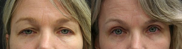 Eyelid Surgery Before & After - Dr. Thomassen