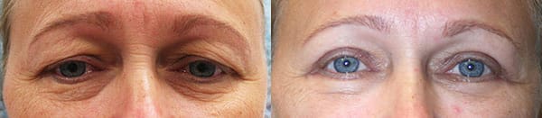 Eyelid Surgery Before & After - Dr. Thomassen