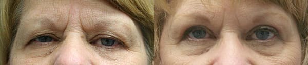 Eyelid Surgery Before & After - Dr. Thomassen