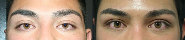 Eyelid Surgery Before & After - Dr. Thomassen