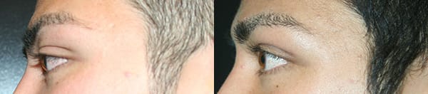 Eyelid Surgery Before & After - Dr. Thomassen