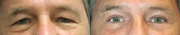 Eyelid Surgery Before & After - Dr. Thomassen