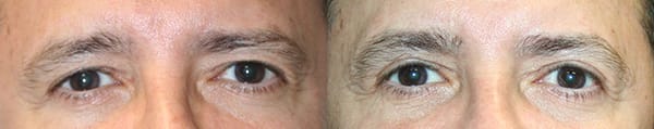 Eyelid Surgery Before & After - Dr. Thomassen