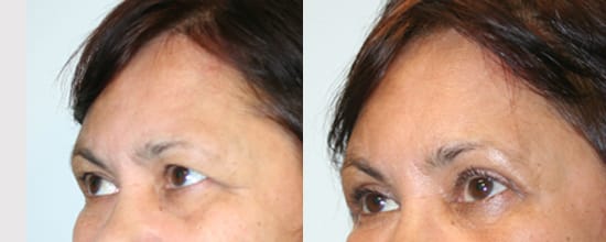 Eyelid Surgery Before & After - Dr. Thomassen