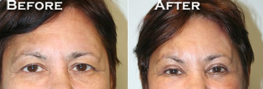 Eyelid Surgery Before & After - Dr. Thomassen