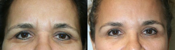 Eyelid Surgery Before & After - Dr. Thomassen