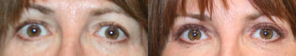 Eyelid Surgery Before & After - Dr. Thomassen