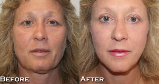 Facelift Before & After - Dr. Thomassen