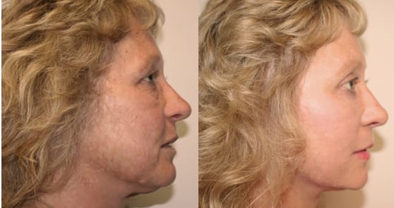 Facelift Before & After - Dr. Thomassen