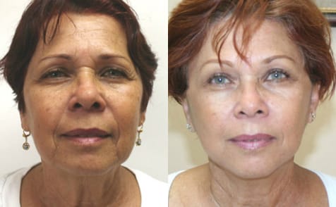 Facelift Before & After - Dr. Thomassen