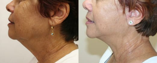 Facelift Before & After - Dr. Thomassen