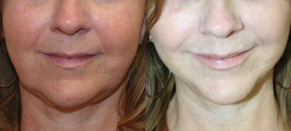 Facelift Before & After - Dr. Thomassen