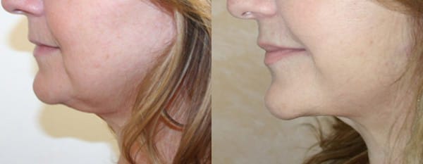 Facelift Before & After - Dr. Thomassen