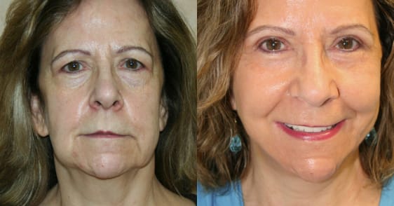 Facelift Before & After - Dr. Thomassen