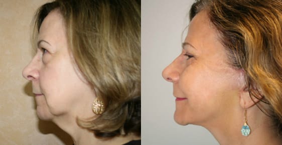 Facelift Before & After - Dr. Thomassen