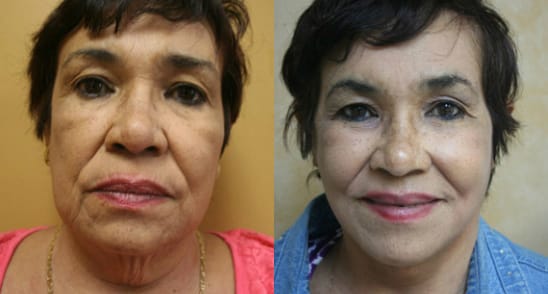 Facelift Before & After - Dr. Thomassen