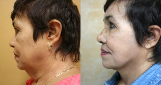 Facelift Before & After - Dr. Thomassen