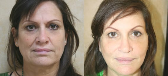 Facelift Before & After - Dr. Thomassen