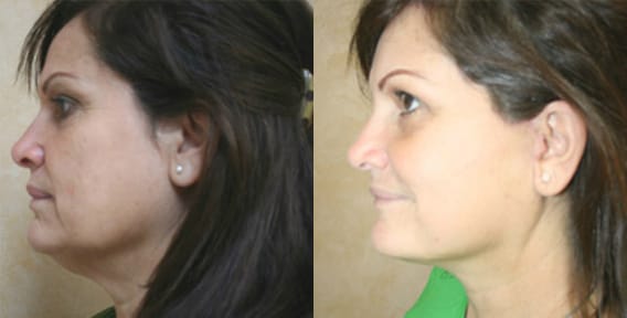Facelift Before & After - Dr. Thomassen