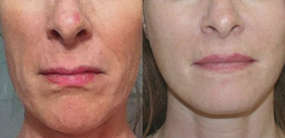 Facelift Before & After - Dr. Thomassen
