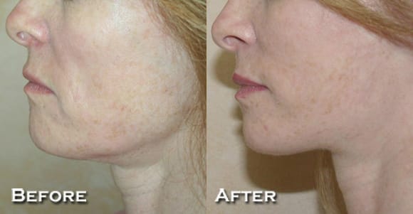 Facelift Before & After - Dr. Thomassen