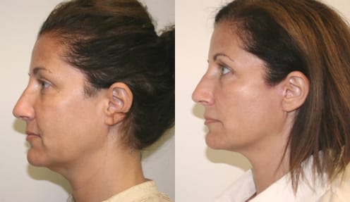 Facelift Before & After - Dr. Thomassen