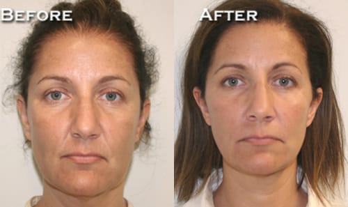 Facelift Before & After - Dr. Thomassen