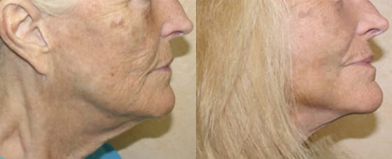 Facelift Before & After - Dr. Thomassen