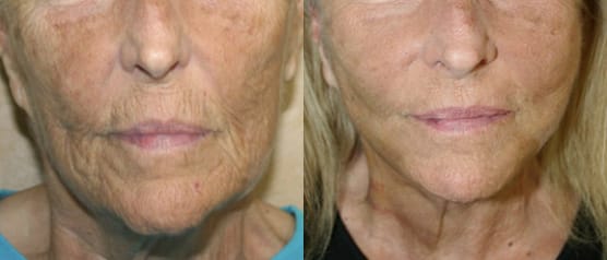Facelift Before & After - Dr. Thomassen