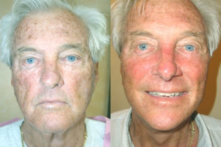 Facelift Before & After - Dr. Thomassen