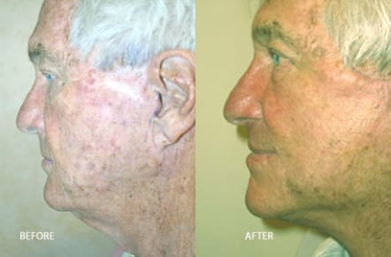 Facelift Before & After - Dr. Thomassen