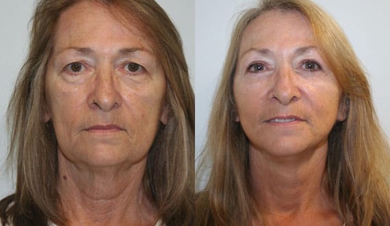 Facelift Before & After - Dr. Thomassen