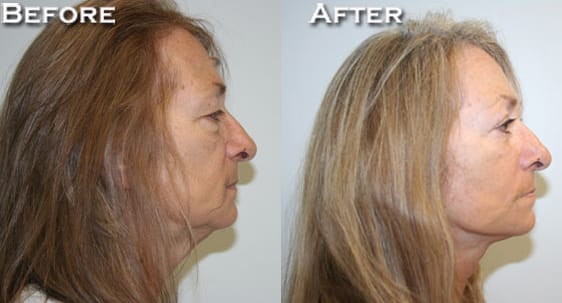 Facelift Before & After - Dr. Thomassen