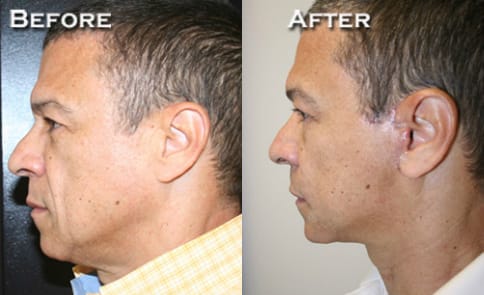 Facelift Before & After - Dr. Thomassen