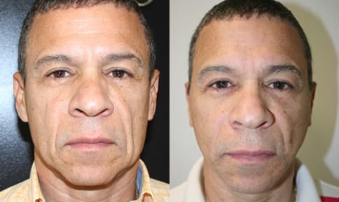 Facelift Before & After - Dr. Thomassen