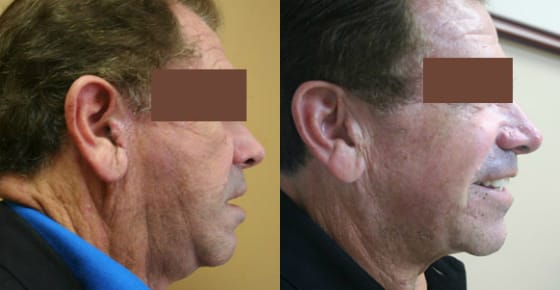 Facelift Before & After - Dr. Thomassen