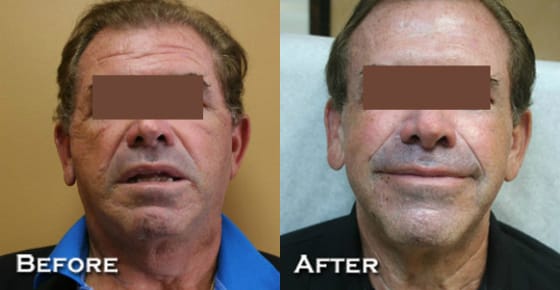 Facelift Before & After - Dr. Thomassen