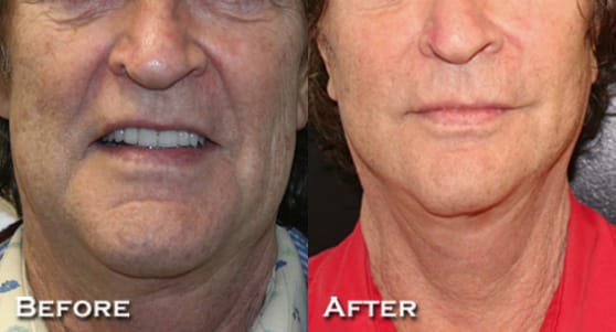 Facelift Before & After - Dr. Thomassen