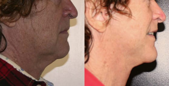Facelift Before & After - Dr. Thomassen