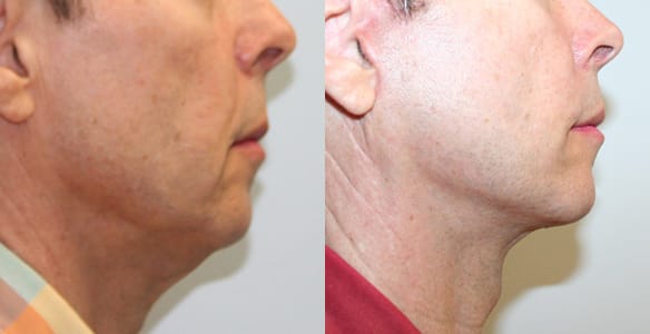 Facelift Before & After - Dr. Thomassen