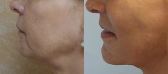 Facelift Before & After - Dr. Thomassen