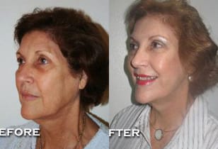 Facelift Before & After - Dr. Thomassen