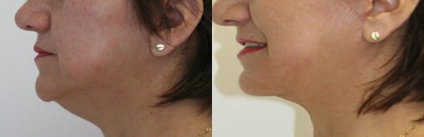 Facelift Before & After - Dr. Thomassen