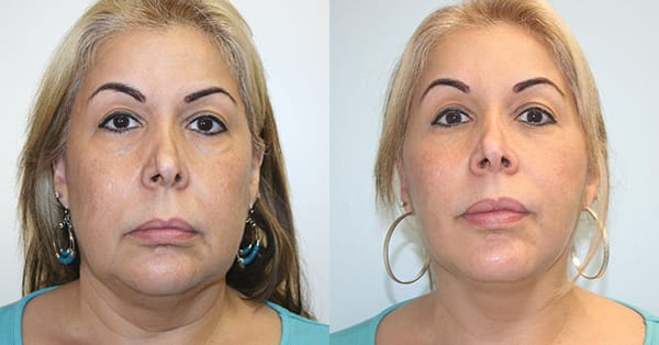 Facelift Before & After - Dr. Thomassen