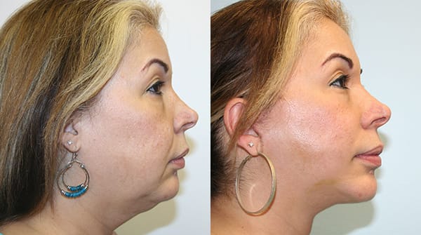 Facelift Before & After - Dr. Thomassen