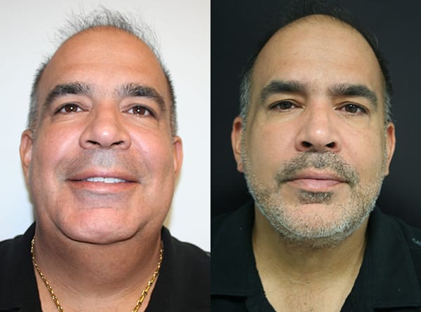 Facelift Before & After - Dr. Thomassen